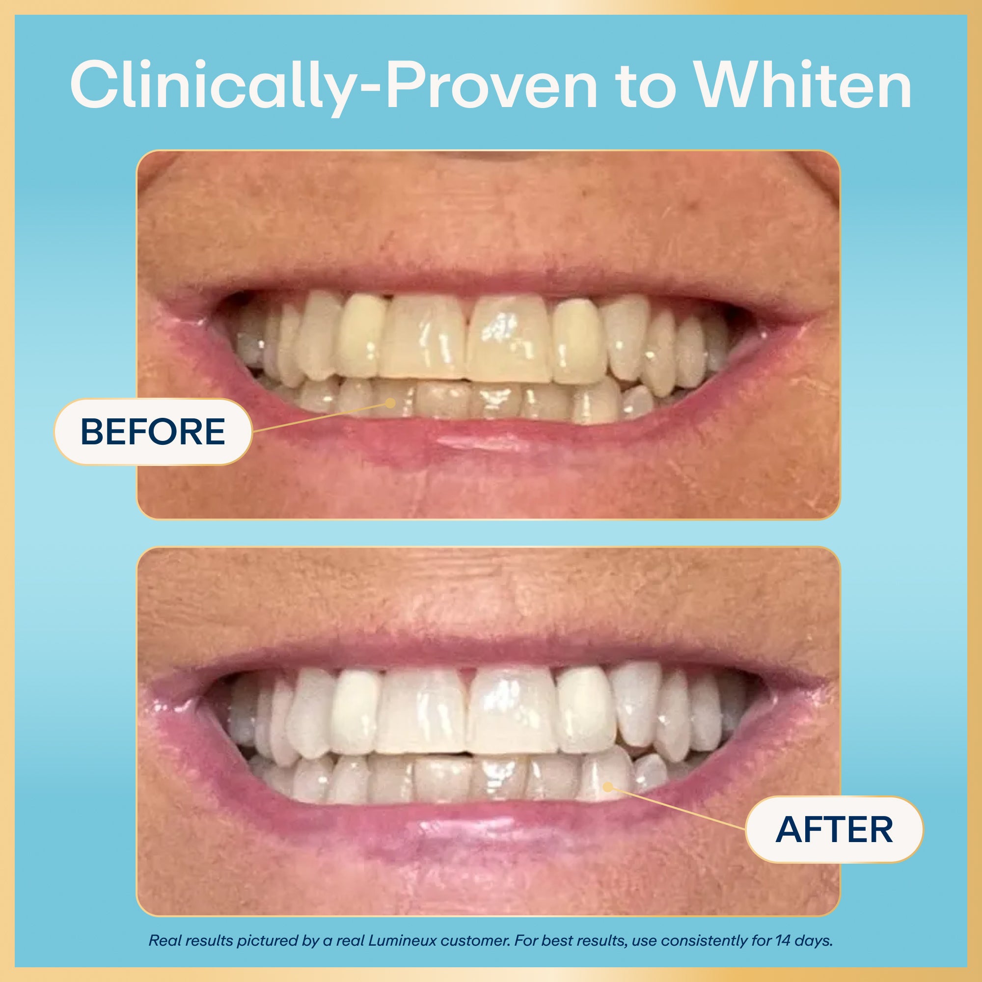 The Lumineux® Bright² Teeth Whitening Pen